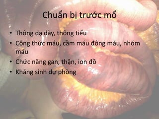 Chuẩn bị trước mổ
• Thông dạ dày, thông tiểu
• Công thức máu, cầm máu đông máu, nhóm
máu
• Chức năng gan, thận, ion đồ
• Kháng sinh dự phòng
 