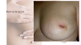 Núm vú bị co rút
 