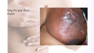 Ung thư giai đoạn
muộn
 