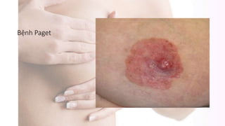 Bệnh Paget
 