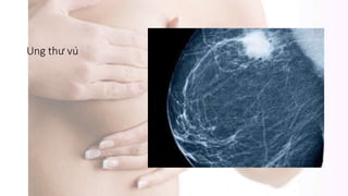 Ung thư vú
 