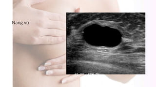 Nang vú
 
