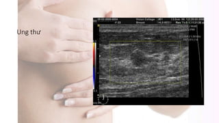 Ung thư
 