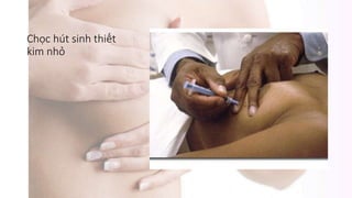 Chọc hút sinh thiết
kim nhỏ
 