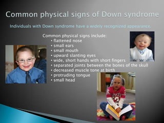  With Trisomy 21 there are 3 copies of chromosome 21, instead of the usual 2 copies.Translocation Down syndrome rare form of Down syndrome