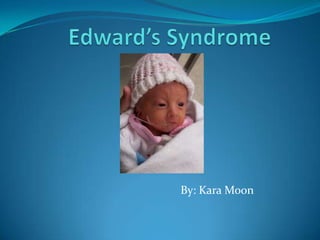 Edward’s Syndrome By: Kara Moon 