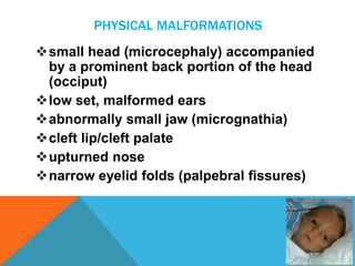 PHYSICAL MALFORMATIONS 
small head (microcephaly) accompanied 
by a prominent back portion of the head 
(occiput) 
low set, malformed ears 
abnormally small jaw (micrognathia) 
cleft lip/cleft palate 
upturned nose 
narrow eyelid folds (palpebral fissures) 
 