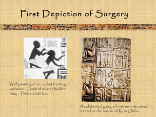 First Depiction of Surgery A celebrated group of instruments carved in relief at the temple of Kom Ombo Wall painting of an oculist treating  a workman . Tomb of master builder Ibwy , Thebe 1200 b.c. 