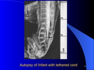 Autopsy of Infant with tethered cord 