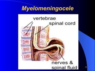 Myelomeningocele 