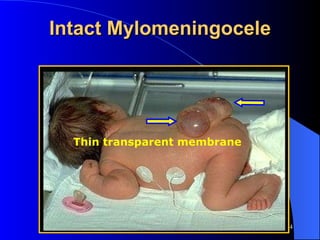 Intact Mylomeningocele Thin transparent membrane 