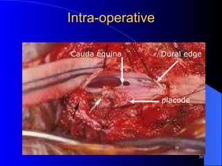 Intra-operative Cauda equina Dural edge placode 