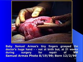 Baby Samuel Armas's tiny fingers grasped the doctor's huge hand - - not at birth but, at 21 weeks during surgery for repair of MM Samuel Armas Photo 8/19/99; Born 12/2/99 