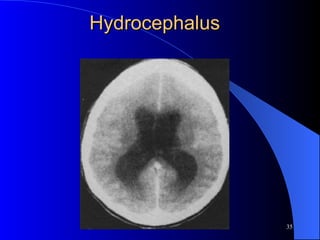 Hydrocephalus 