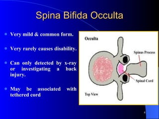Spina Bifida Occulta Very mild & common form.  Very rarely causes disability.  Can only detected by x-ray or investigating a back injury.  May be associated with tethered cord 