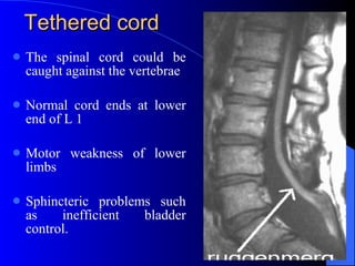 Tethered cord  The spinal cord could be caught against the vertebrae  Normal cord ends at lower end of L 1 Motor weakness of lower limbs Sphincteric problems such as inefficient bladder control.  