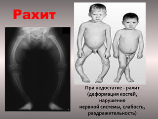 Рахит

При недостатке - рахит
(деформация костей,
нарушения
нервной системы, слабость,
раздражительность)

 