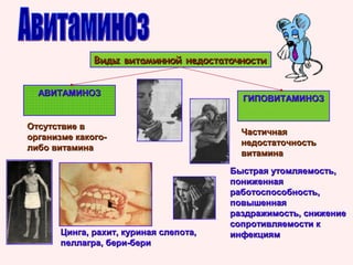 Виды витаминной недостаточности
АВИТАМИНОЗ

Отсутствие в
организме какоголибо витамина

Цинга, рахит, куриная слепота,
пеллагра, бери-бери

ГИПОВИТАМИНОЗ

Частичная
недостаточность
витамина
Быстрая утомляемость,
пониженная
работоспособность,
повышенная
раздражимость, снижение
сопротивляемости к
инфекциям

 
