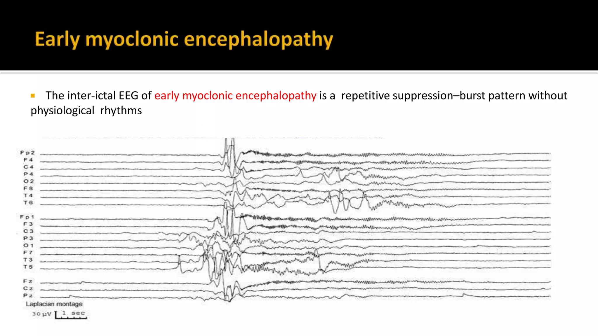  The inter-ictal EEG of early myoclonic encephalopathy is a repetitive suppression–burst pattern without
physiological rhythms
 