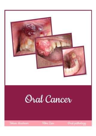 Oral Cancer
Toleen Mazloum Hiba Zein Oral pathology
 