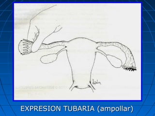 EXPRESION TUBARIA (ampollar)EXPRESION TUBARIA (ampollar)
 