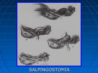 SALPINGOSTOMIASALPINGOSTOMIA
 