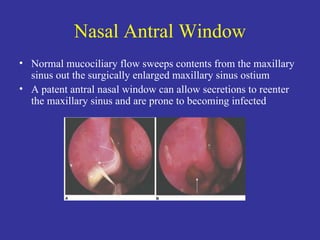 Nasal Antral Window Normal mucociliary flow sweeps contents from the maxillary sinus out the surgically enlarged maxillary sinus ostium A patent antral nasal window can allow secretions to reenter the maxillary sinus and are prone to becoming infected 