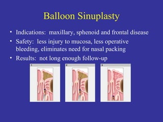 Balloon Sinuplasty Indications:  maxillary, sphenoid and frontal disease Safety:  less injury to mucosa, less operative bleeding, eliminates need for nasal packing Results:  not long enough follow-up 