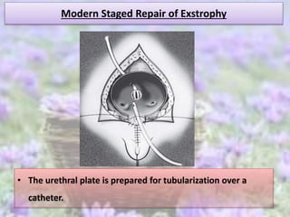 Modern Staged Repair of Exstrophy
• The urethral plate is prepared for tubularization over a
catheter.
 