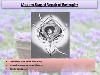 Modern Staged Repair of Exstrophy
• The urethral plate is now tubularized,
• ureteral catheters are placed bilaterally
• Bladder being closed
 