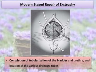 Modern Staged Repair of Exstrophy
• Completion of tubularization of the bladder and urethra, and
location of the various drainage tubes
 