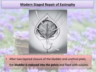 Modern Staged Repair of Exstrophy
• After two-layered closure of the bladder and urethral plate,
the bladder is reduced into the pelvis and fixed with sutures.
 