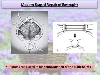 Modern Staged Repair of Exstrophy
• Sutures are placed to for approximation of the pubic halves
 