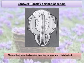 Cantwell-Ransley epispadias repair.
• The urethral plate is dissected from the corpora and is tubularized
 