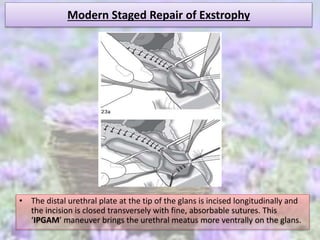 Modern Staged Repair of Exstrophy
• The distal urethral plate at the tip of the glans is incised longitudinally and
the incision is closed transversely with fine, absorbable sutures. This
‘IPGAM’ maneuver brings the urethral meatus more ventrally on the glans.
 