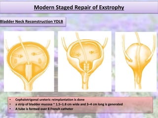 Modern Staged Repair of Exstrophy
• Cephalotrigonal ureteric reimplantation is done
• a strip of bladder mucosa ~ 1.5–1.8 cm wide and 3–4 cm long is generated
• A tube is formed over 8 French catheter
Bladder Neck Reconstruction YDLB
 