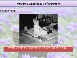 Modern Staged Repair of Exstrophy
Results of BNR
• Bryant’s traction after exstrophy closure without osteotomies.
 
