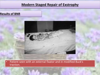 Modern Staged Repair of Exstrophy
Results of BNR
• Patient seen with an external fixator and in modified Buck’s
traction.
 