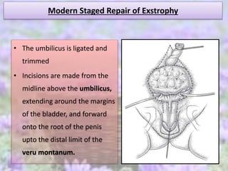 Modern Staged Repair of Exstrophy
• The umbilicus is ligated and
trimmed
• Incisions are made from the
midline above the umbilicus,
extending around the margins
of the bladder, and forward
onto the root of the penis
upto the distal limit of the
veru montanum.
 