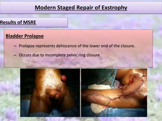 Modern Staged Repair of Exstrophy
Bladder Prolapse
– Prolapse represents dehiscence of the lower end of the closure.
– Occurs due to incomplete pelvic ring closure
Results of MSRE
 