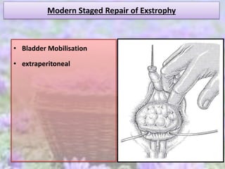 Modern Staged Repair of Exstrophy
• Bladder Mobilisation
• extraperitoneal
 