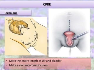 CPRE
• Mark the entire length of UP and bladder
• Make a circumcoronal incision
Technique
 