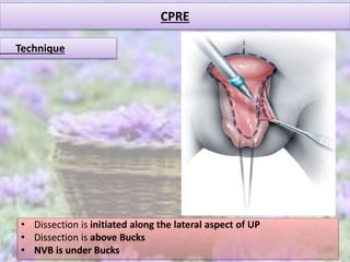 CPRE
• Dissection is initiated along the lateral aspect of UP
• Dissection is above Bucks
• NVB is under Bucks
Technique
 