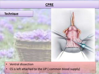 CPRE
• Ventral dissection
• CS is left attached to the UP ( common blood supply)
Technique
 