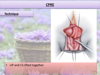 CPRE
• UP and CS lifted together
Technique
 
