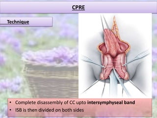 CPRE
• Complete disassembly of CC upto intersymphyseal band
• ISB is then divided on both sides
Technique
 