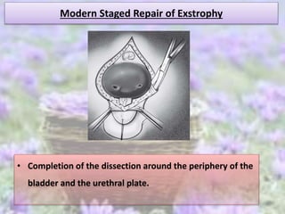Modern Staged Repair of Exstrophy
• Completion of the dissection around the periphery of the
bladder and the urethral plate.
 