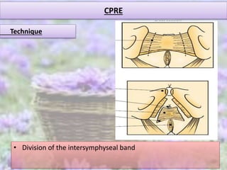 CPRE
• Division of the intersymphyseal band
Technique
 