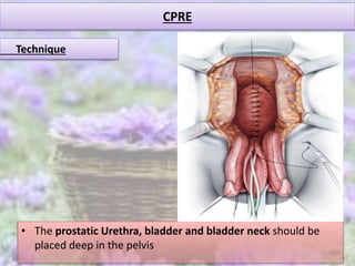 CPRE
• The prostatic Urethra, bladder and bladder neck should be
placed deep in the pelvis
Technique
 