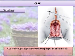 CPRE
• CCs are brought together by suturing edges of Bucks Fascia
Technique
 